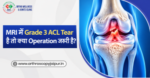 MRI में Grade 3 ACL Tear है तो क्या Operation जरूरी है?